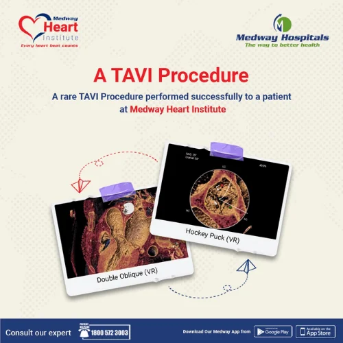 A Rare TAVI Procedure Performed Successfully at Medway Heart Institute