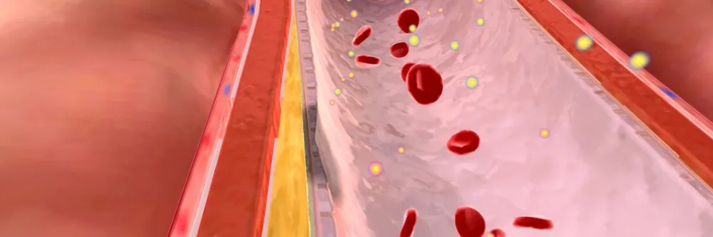 Hyperlipidemia