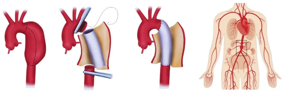 Aortic Aneurysm