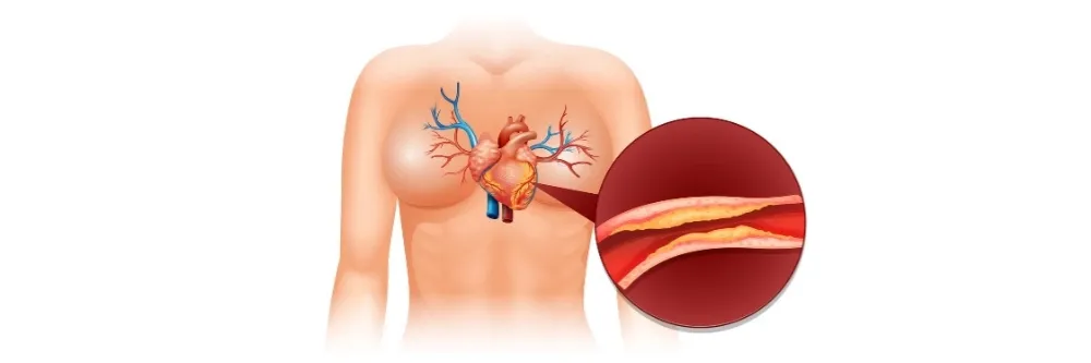 Coronary Artery Disease (CAD)