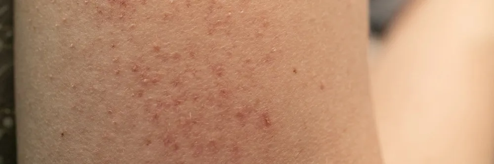 Candidiasis