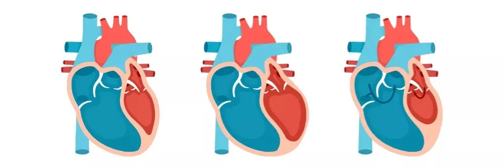 Arrhythmias