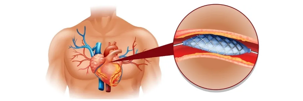 Valvular Heart Disease