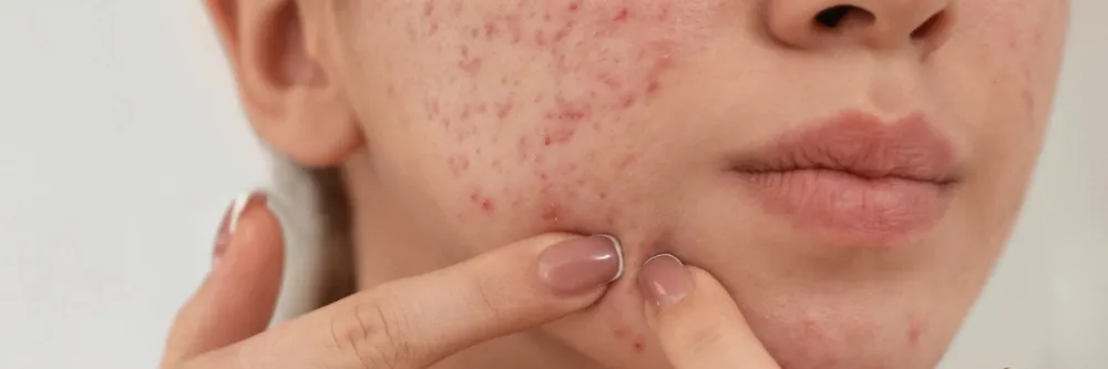 Acne