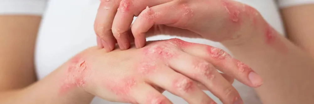 Eczema