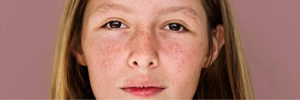 Hyperpigmentation