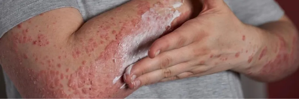 Psoriasis
