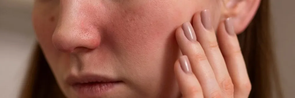 Rosacea
