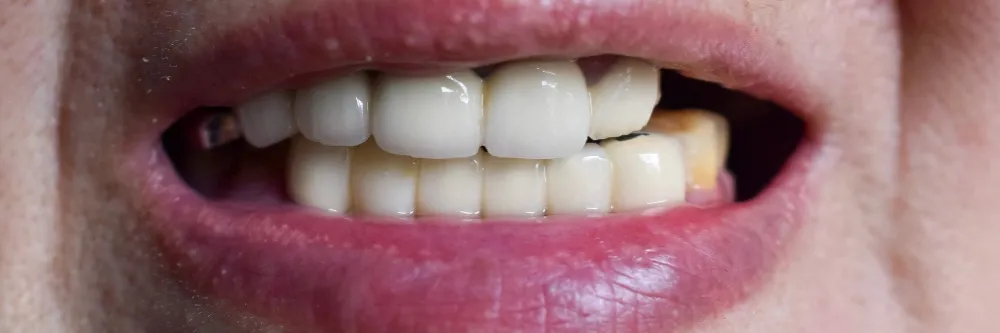 Impacted Teeth