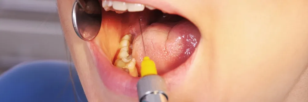 Oral Cancer