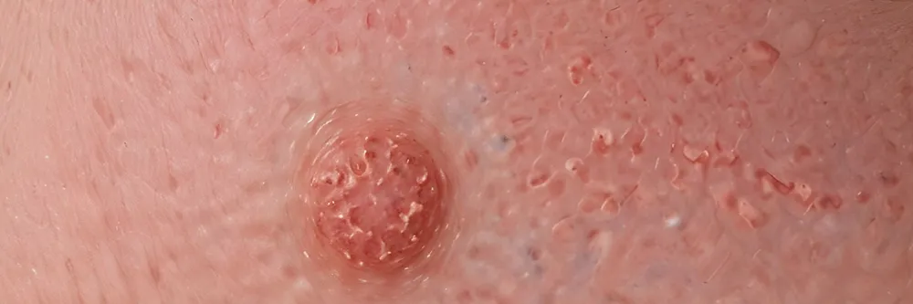 Actinic Keratosis