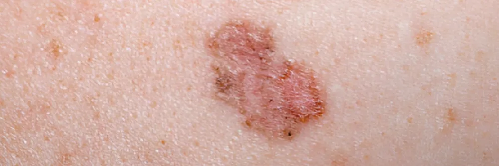 Basal Cell Carcinoma