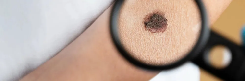 Melanoma
