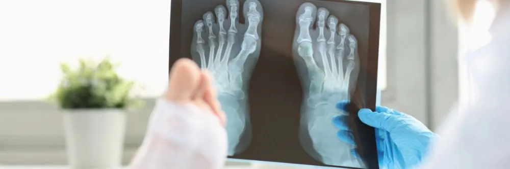 Osteoporosis