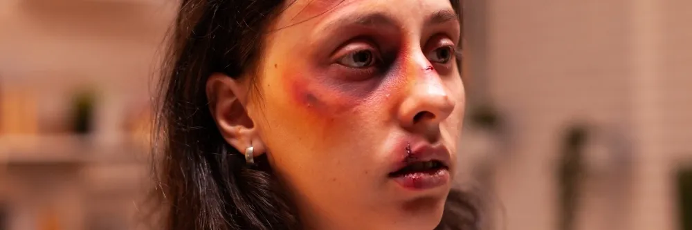 Facial Trauma