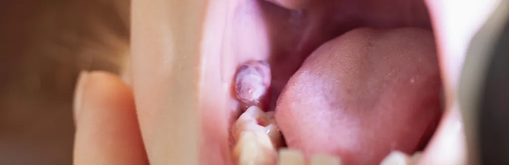 Oral Infections