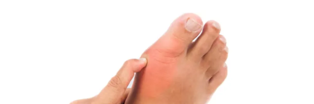 Plantar Fasciitis