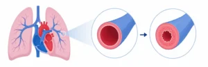 Pulmonary Hypertension