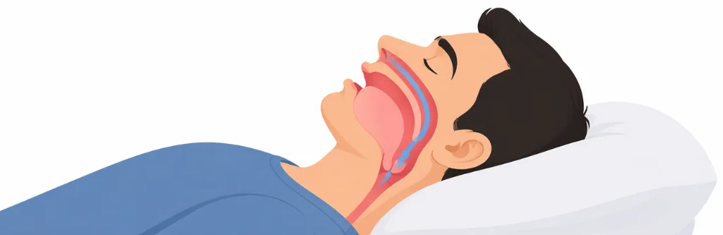 Sleep Apnea