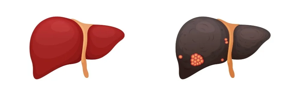 Liver Cancer