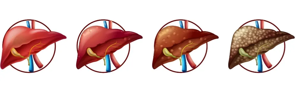 Liver Cirrhosis