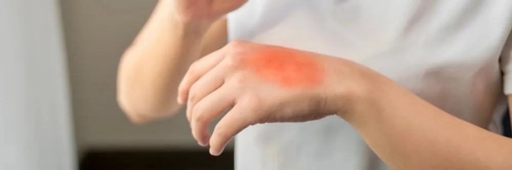 Severe Burns