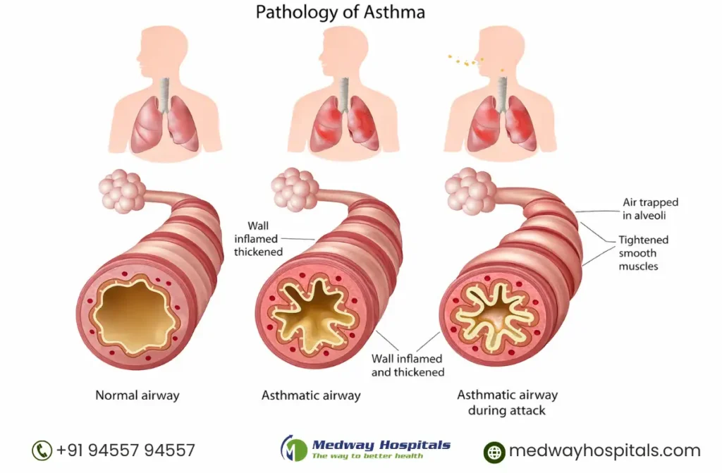 Best Asthma Hospital in chennai