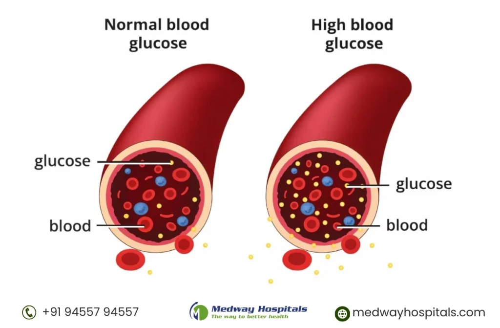 Best Diabetes Treatment in Chennai