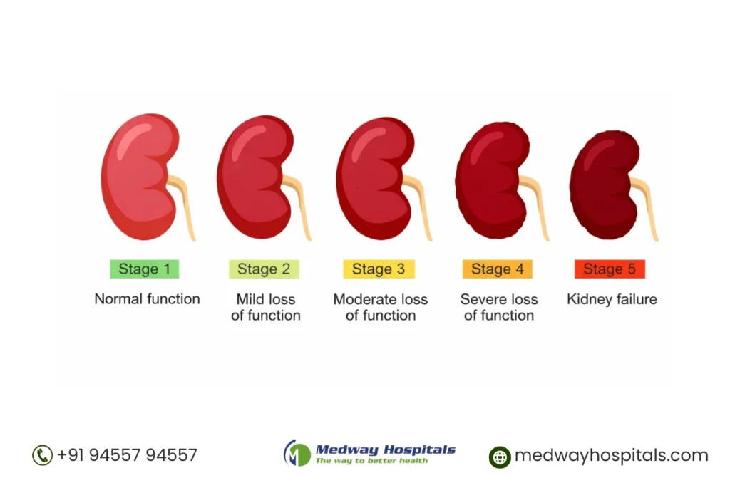 Best Nephrology Hospital in Chennai