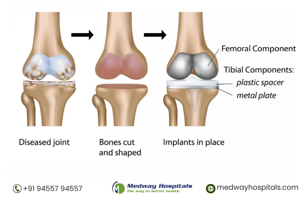 Best Orthopedic Hospitals in Chennai