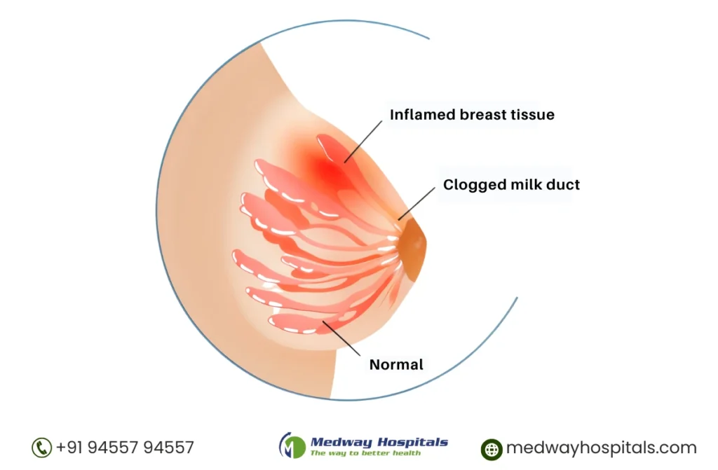 Breast Pain After Pregnancy