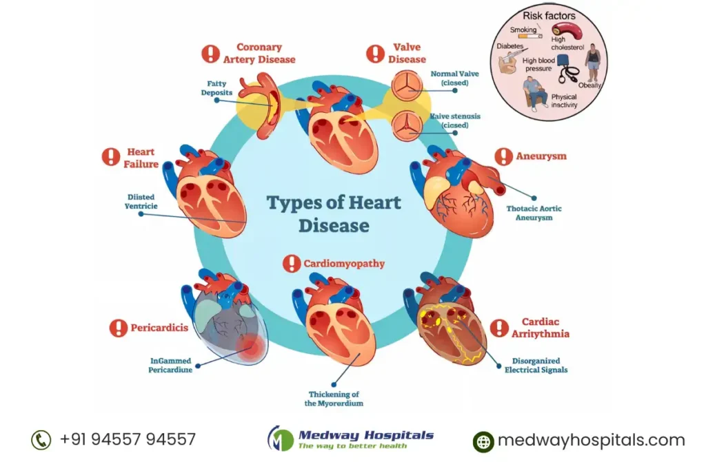Cardiac Specialist in Chennai
