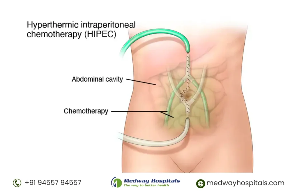 HIPEC with ThermoChem™ HT-2000: A Game-Changer in Advanced Cancer Care