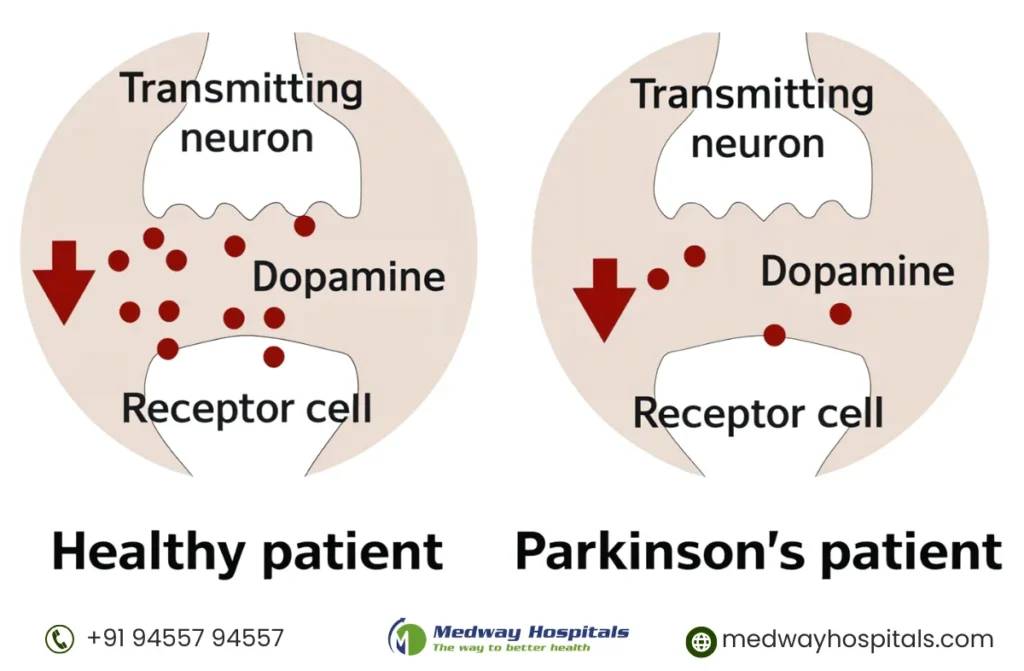 Parkinson's Disease Treatment In Chennai