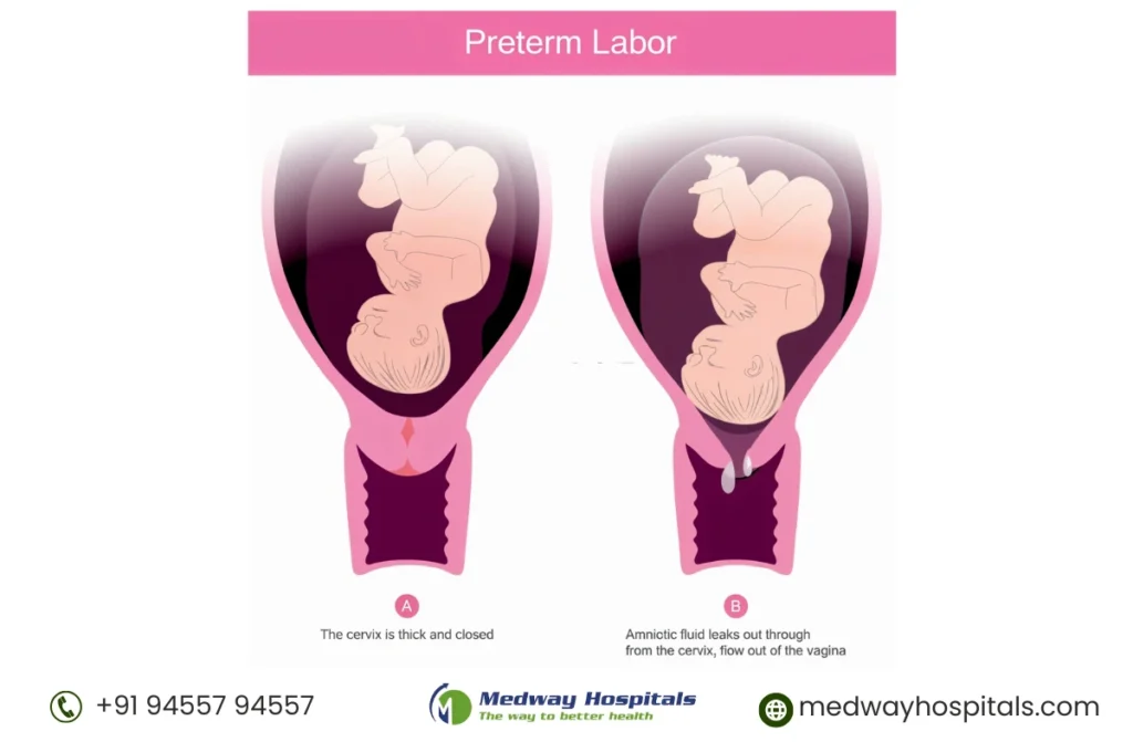 Premature Birth Complications