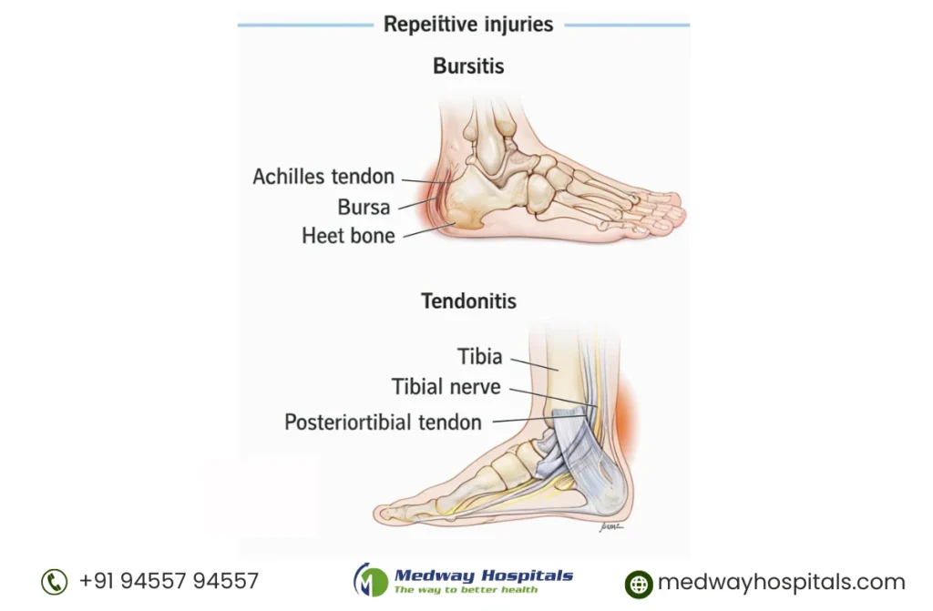 Soft Tissue Injuries