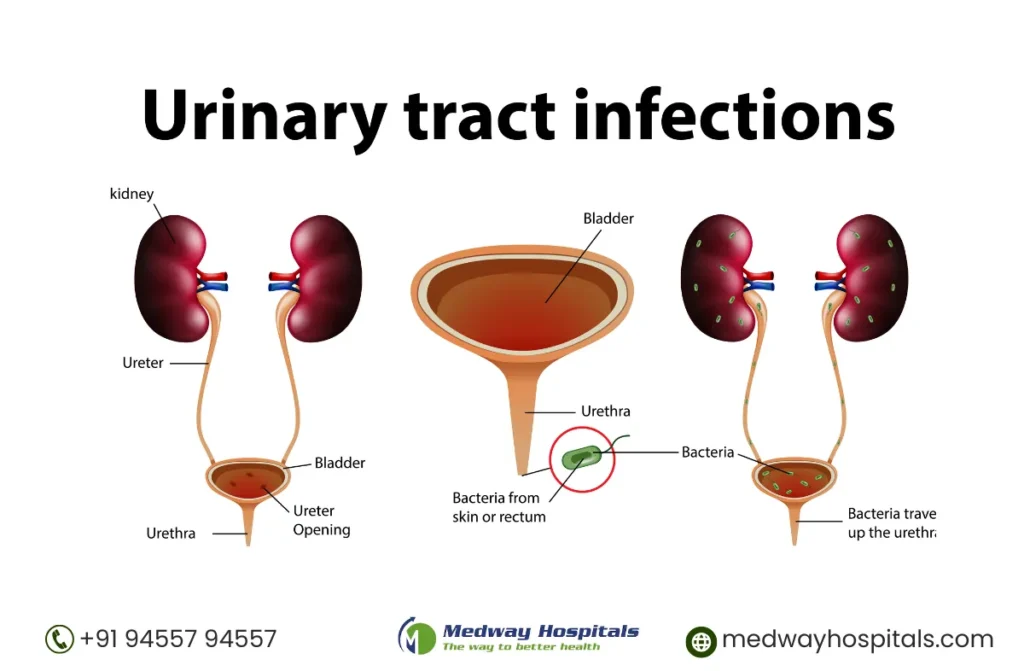 Stages of Kidney failure