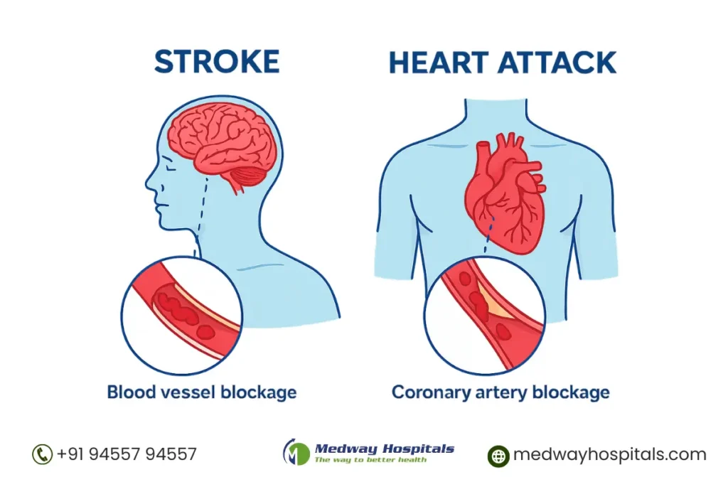 Stroke vs. Heart Attack