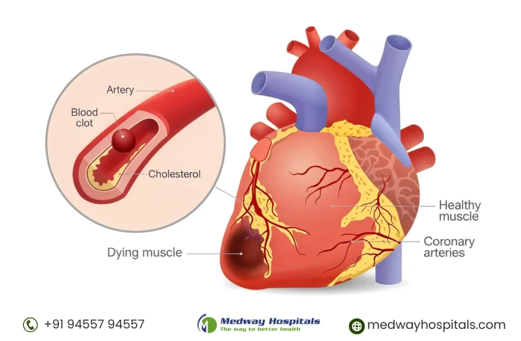 Type 2 Diabetes and Heart Failure Treatment