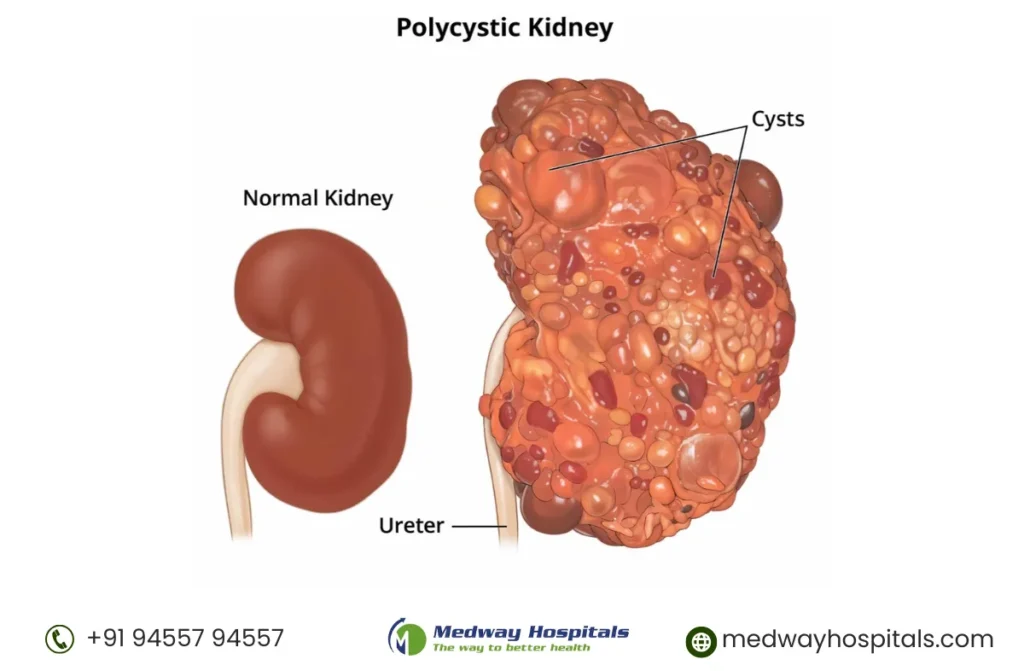 Weight Gain Kidney Disease