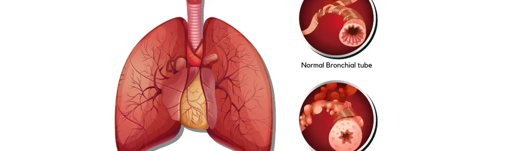 Cystic Fibrosis in the lungs | Medway Hospitals