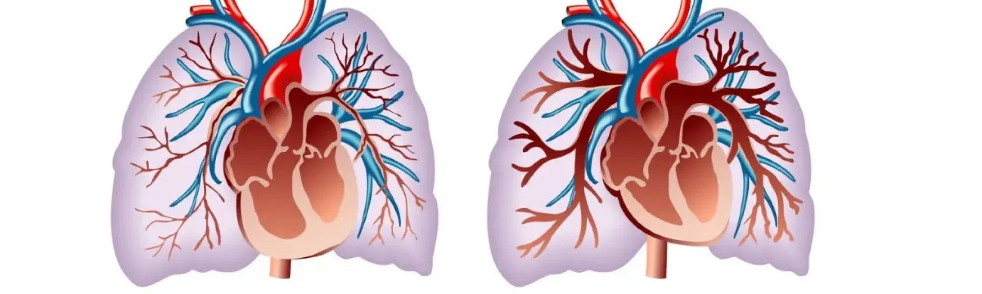pulmonary hypertension treatment | Medway Hospitals